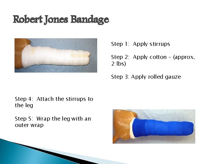 Robert Jones Bandage Step 1: Apply stirrups Step 2: Apply cotton – (approx. 2