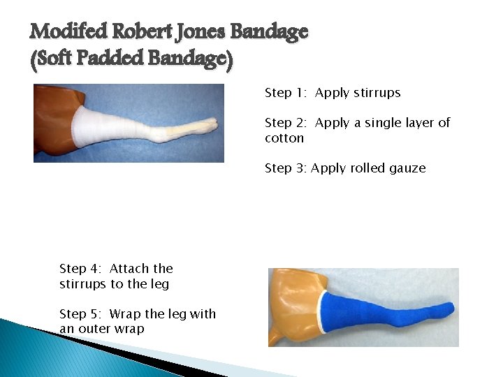 Modifed Robert Jones Bandage (Soft Padded Bandage) Step 1: Apply stirrups Step 2: Apply