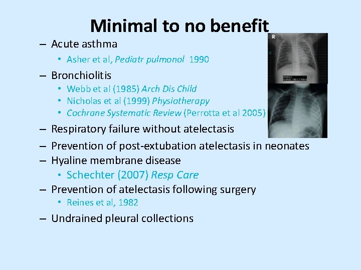 Minimal to no benefit – Acute asthma • Asher et al, Pediatr pulmonol 1990