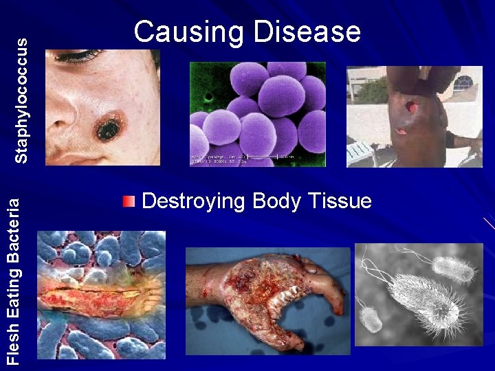 Staphylococcus Flesh Eating Bacteria Causing Disease Destroying Body Tissue 