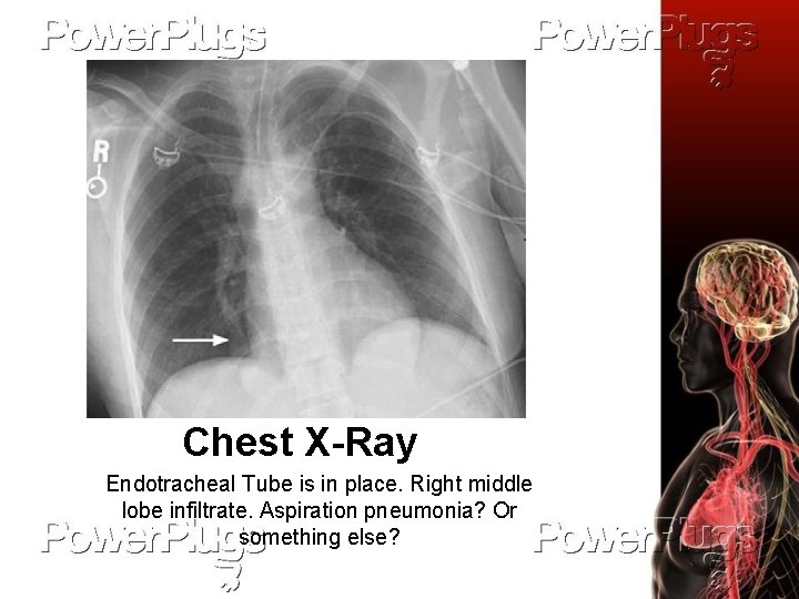 Chest X-Ray Endotracheal Tube is in place. Right middle lobe infiltrate. Aspiration pneumonia? Or