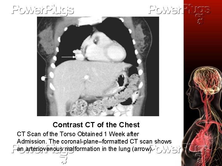 Contrast CT of the Chest CT Scan of the Torso Obtained 1 Week after