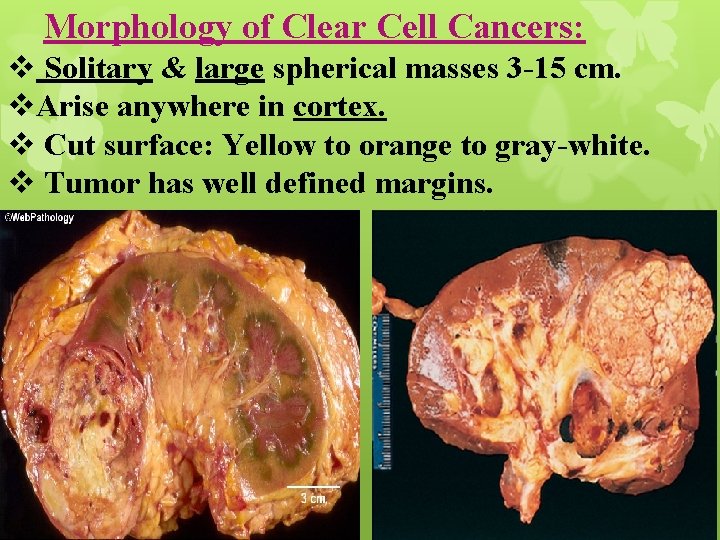 Morphology of Clear Cell Cancers: v Solitary & large spherical masses 3 -15 cm.
