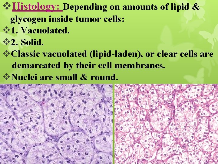 v. Histology: Depending on amounts of lipid & glycogen inside tumor cells: v 1.