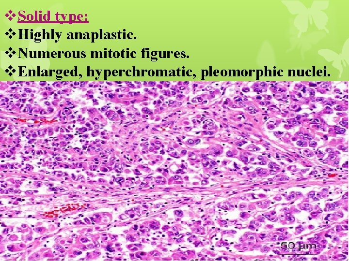 v. Solid type: v. Highly anaplastic. v. Numerous mitotic figures. v. Enlarged, hyperchromatic, pleomorphic