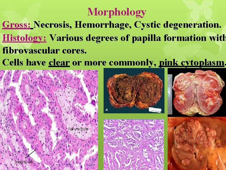 Morphology Gross: Necrosis, Hemorrhage, Cystic degeneration. Histology: Various degrees of papilla formation with fibrovascular