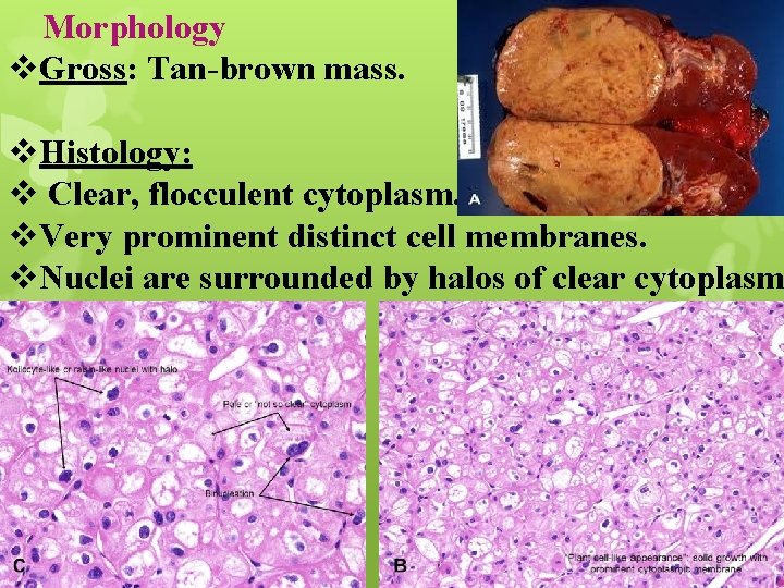 Morphology v. Gross: Tan-brown mass. v. Histology: v Clear, flocculent cytoplasm. v. Very prominent