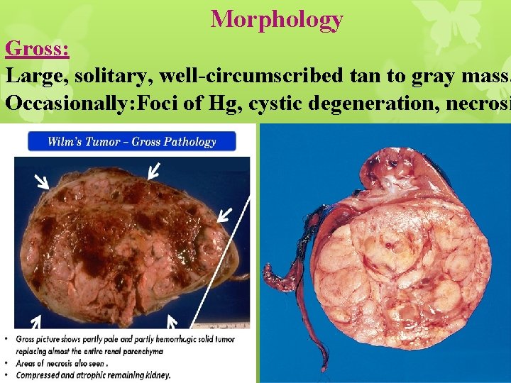 Morphology Gross: Large, solitary, well-circumscribed tan to gray mass. Occasionally: Foci of Hg, cystic