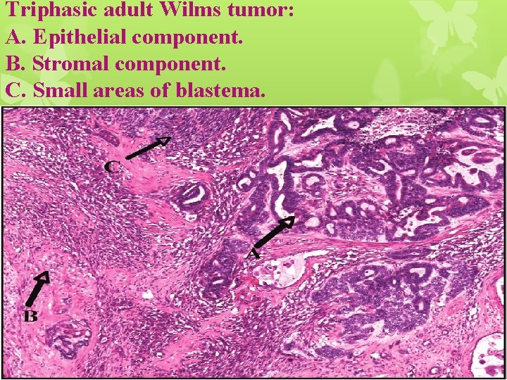 Triphasic adult Wilms tumor: A. Epithelial component. B. Stromal component. C. Small areas of