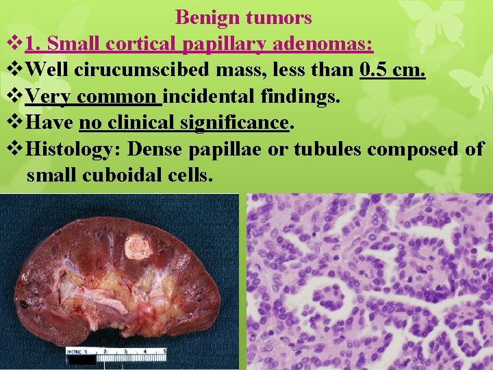 Benign tumors v 1. Small cortical papillary adenomas: v. Well cirucumscibed mass, less than