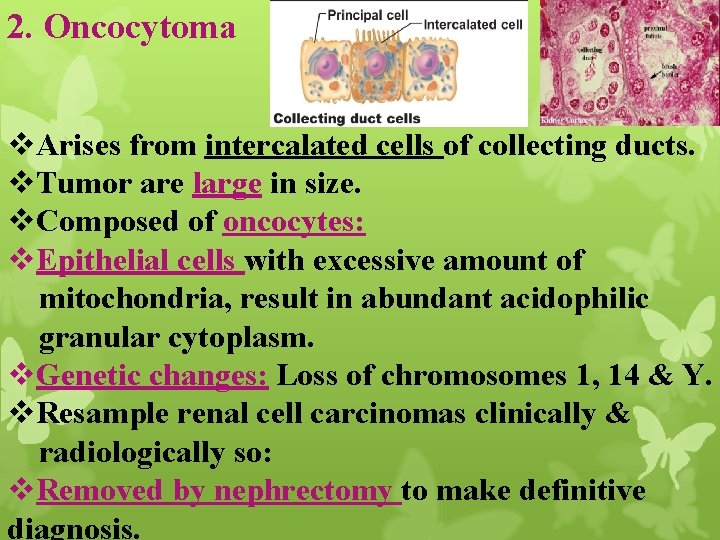 2. Oncocytoma v. Arises from intercalated cells of collecting ducts. v. Tumor are large