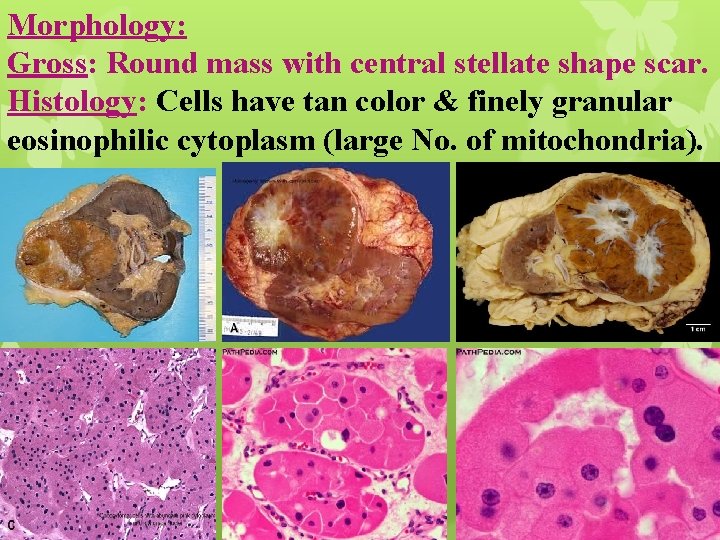 Morphology: Gross: Round mass with central stellate shape scar. Histology: Cells have tan color