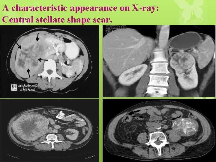 A characteristic appearance on X-ray: Central stellate shape scar. 