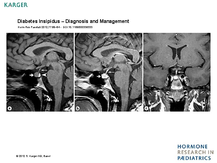 Diabetes Insipidus – Diagnosis and Management Horm Res Paediatr 2012; 77: 69– 84 -