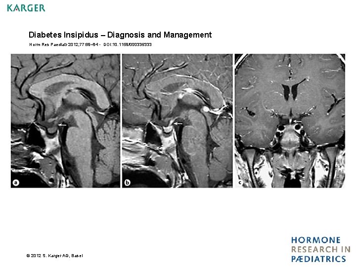 Diabetes Insipidus – Diagnosis and Management Horm Res Paediatr 2012; 77: 69– 84 -