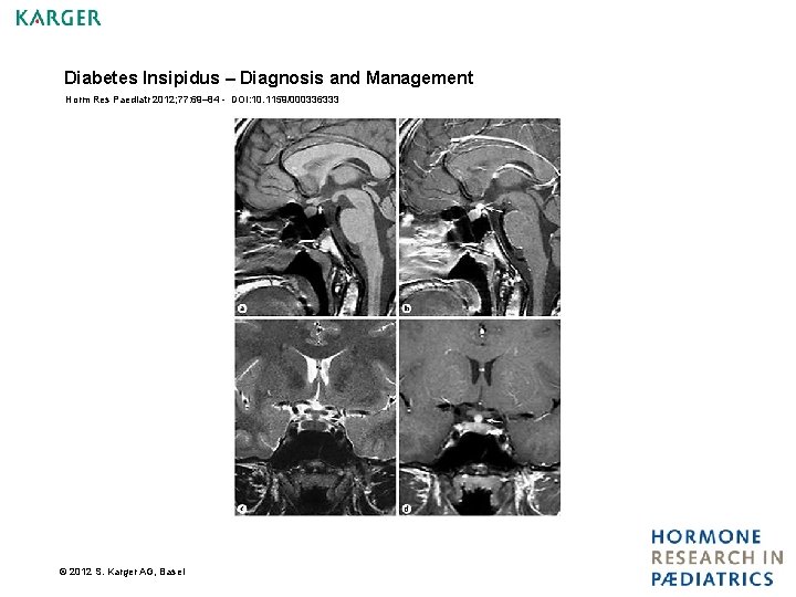Diabetes Insipidus – Diagnosis and Management Horm Res Paediatr 2012; 77: 69– 84 -
