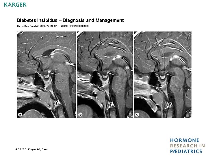 Diabetes Insipidus – Diagnosis and Management Horm Res Paediatr 2012; 77: 69– 84 -