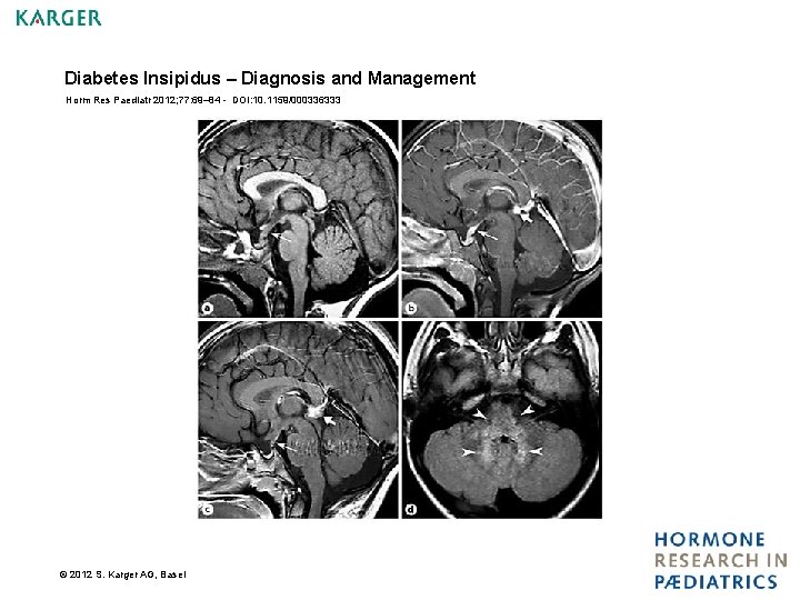 Diabetes Insipidus – Diagnosis and Management Horm Res Paediatr 2012; 77: 69– 84 -