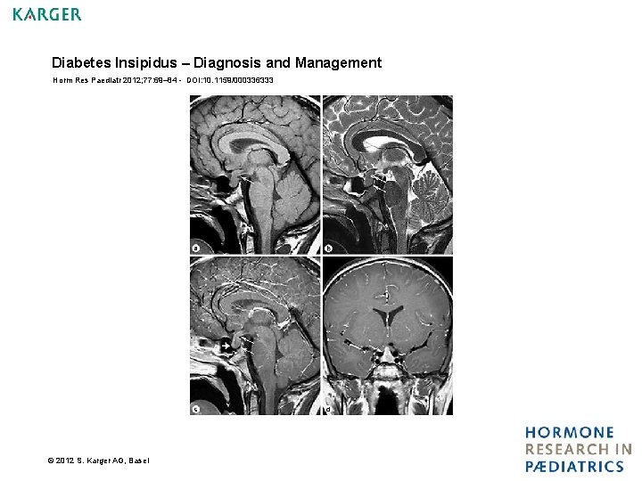 Diabetes Insipidus – Diagnosis and Management Horm Res Paediatr 2012; 77: 69– 84 -