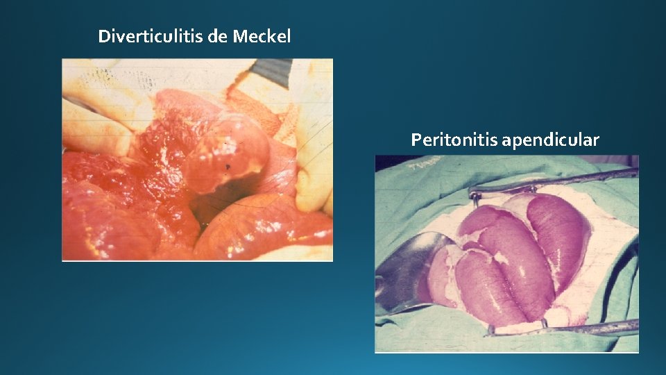 Diverticulitis de Meckel Peritonitis apendicular 