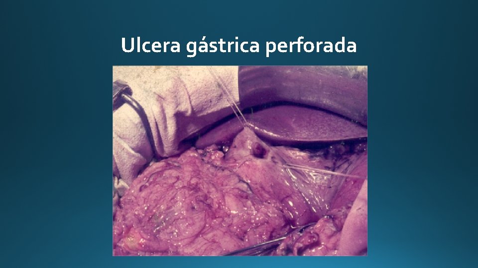 Ulcera gástrica perforada 