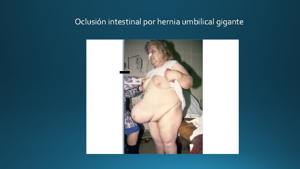 Oclusión intestinal por hernia umbilical gigante 