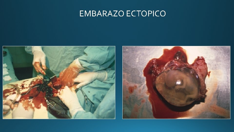 EMBARAZO ECTOPICO 