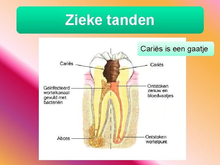 Zieke tanden Cariës is een gaatje 