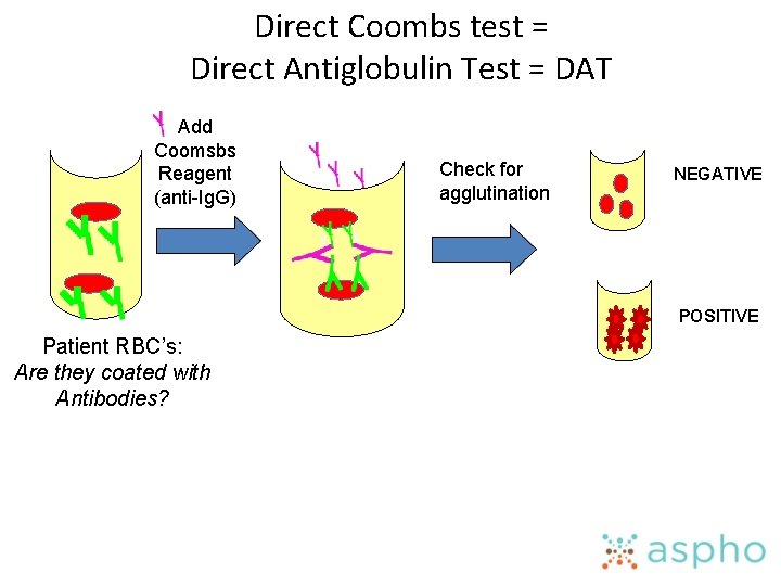 Direct Coombs test = Direct Antiglobulin Test = DAT Add Coomsbs Reagent (anti-Ig. G)