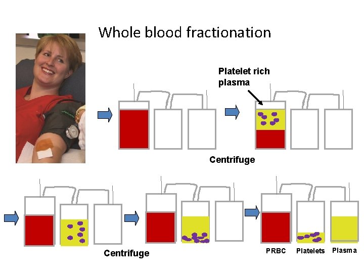 Whole blood fractionation Platelet rich plasma Centrifuge PRBC Platelets Plasma 
