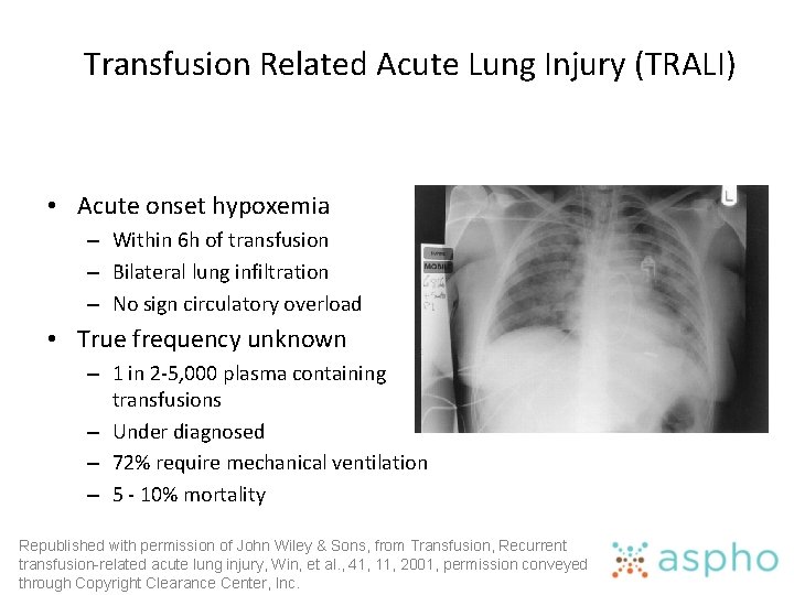 Transfusion Related Acute Lung Injury (TRALI) • Acute onset hypoxemia – Within 6 h