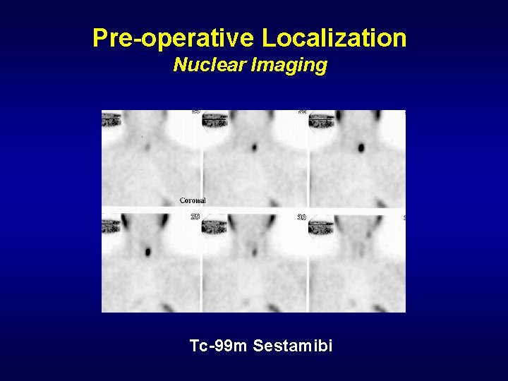 Pre-operative Localization Nuclear Imaging Tc-99 m Sestamibi 