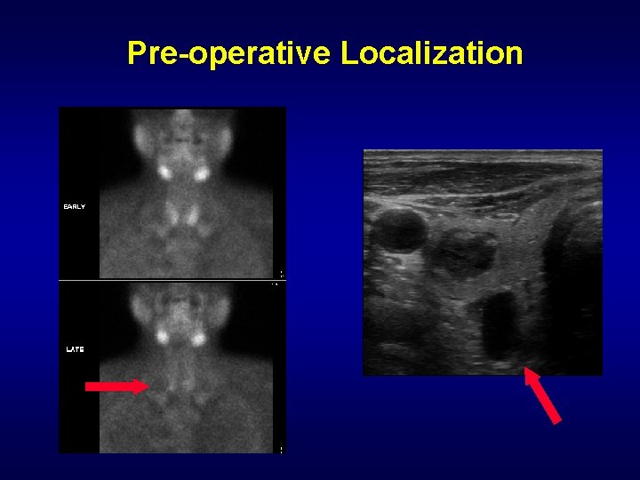 Pre-operative Localization 