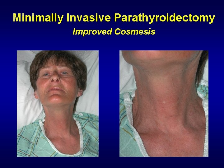 Minimally Invasive Parathyroidectomy Improved Cosmesis 