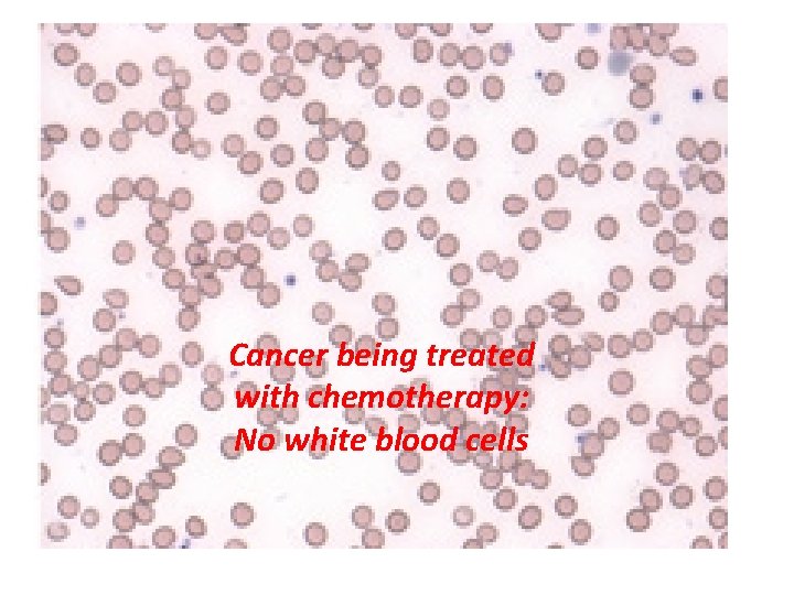 Cancer being treated with chemotherapy: No white blood cells 