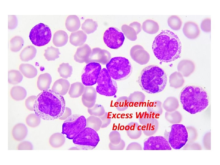 Leukaemia: Excess White blood cells 