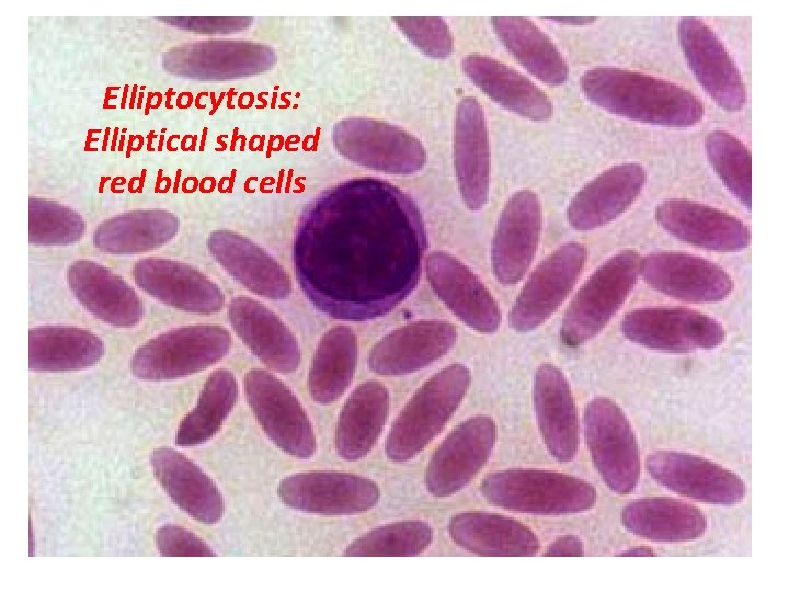 Elliptocytosis: Elliptical shaped red blood cells 