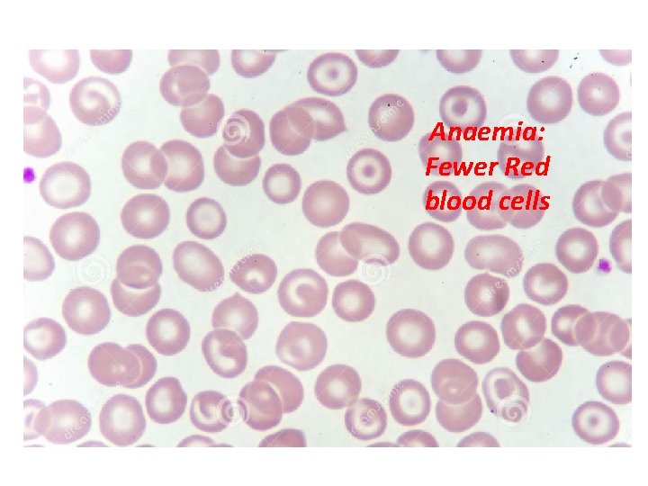 Anaemia: Fewer Red blood cells 