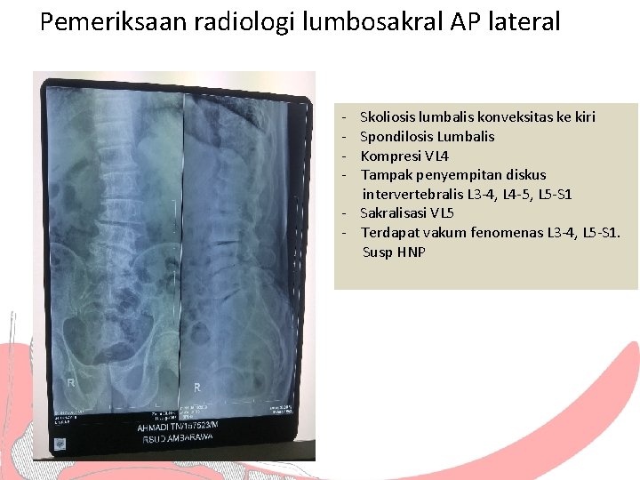 Pemeriksaan radiologi lumbosakral AP lateral - Skoliosis lumbalis konveksitas ke kiri Spondilosis Lumbalis Kompresi