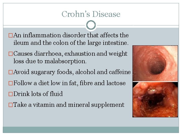 Crohn’s Disease �An inflammation disorder that affects the ileum and the colon of the