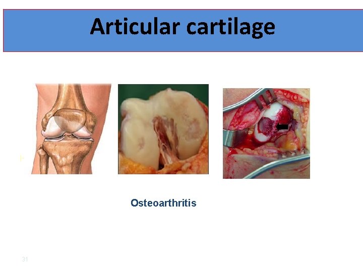 Articular cartilage Healthy Joint Trumatic injury Osteoarthritis 31 