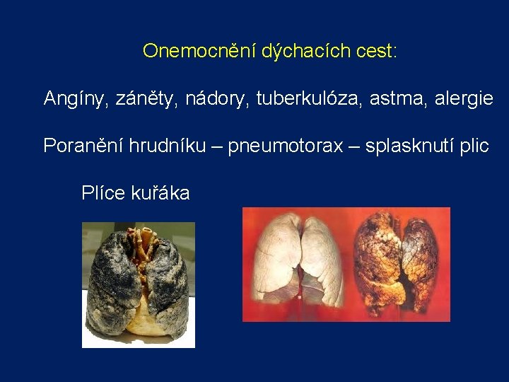 Onemocnění dýchacích cest: Angíny, záněty, nádory, tuberkulóza, astma, alergie Poranění hrudníku – pneumotorax –