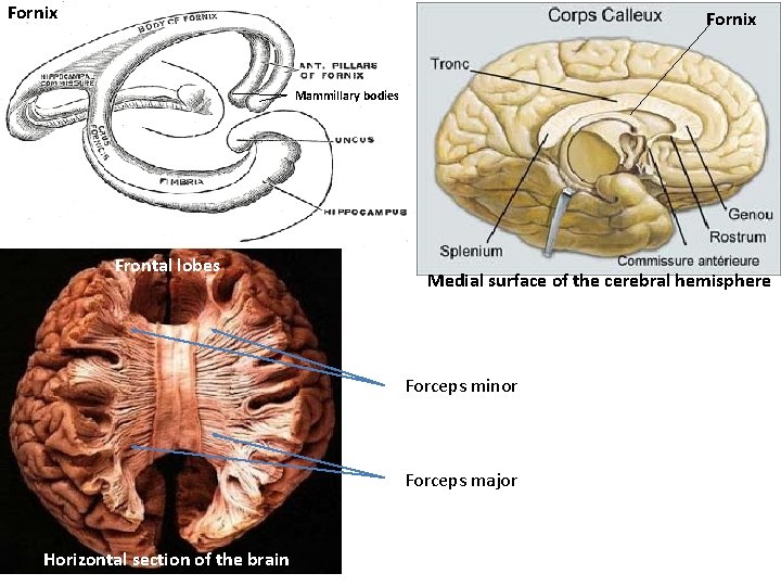 Fornix Mammillary bodies Frontal lobes Medial surface of the cerebral hemisphere Forceps minor Forceps