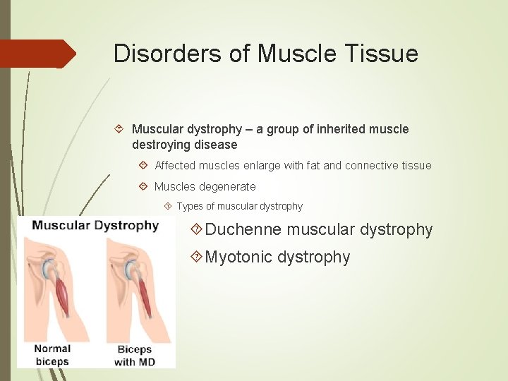 Disorders of Muscle Tissue Muscular dystrophy – a group of inherited muscle destroying disease