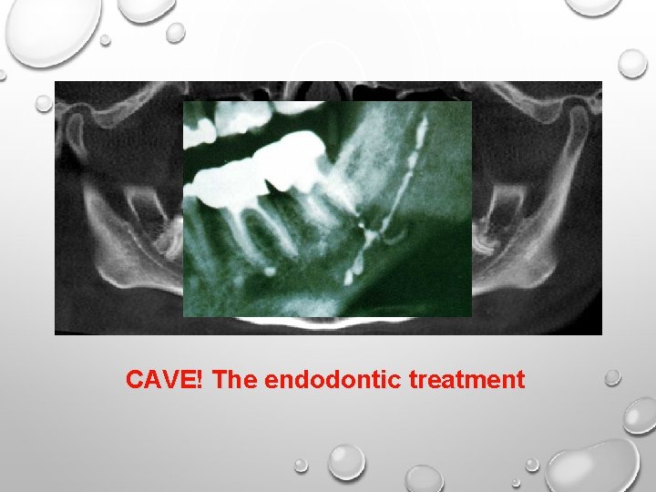 CAVE! The endodontic treatment 