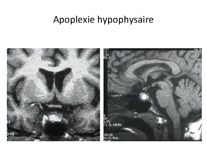 Apoplexie hypophysaire 