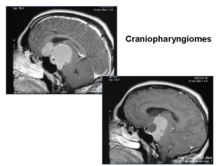 Craniopharyngiomes 