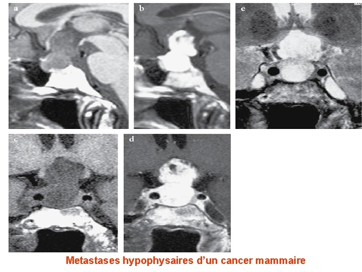 Metastases hypophysaires d’un cancer mammaire 