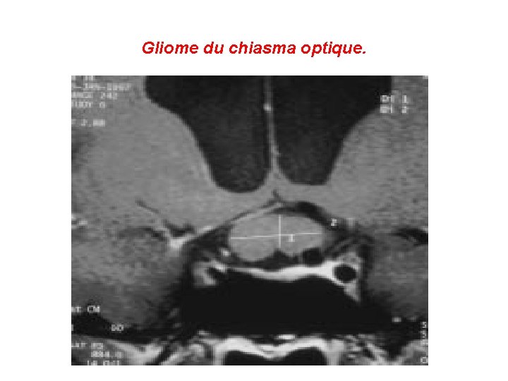 Gliome du chiasma optique. 