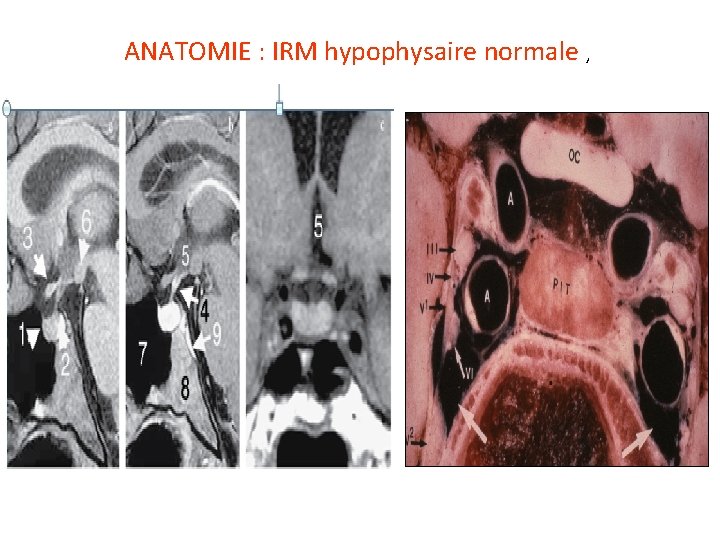 ANATOMIE : IRM hypophysaire normale , 